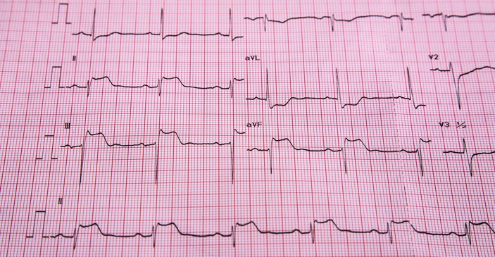 EKG - STEMI - tecken på ST-höjning och hjärtmuskelinfarkt