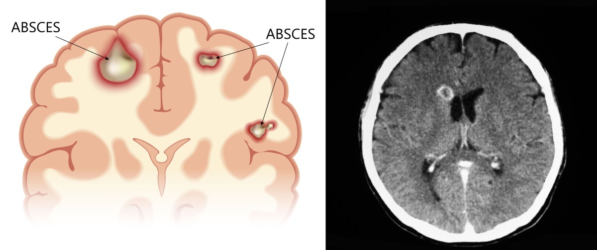 Anatomiska vyer och CT-skanningar av en hjärnabscess