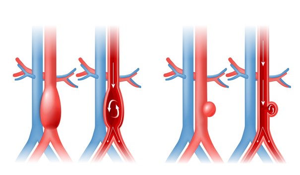 Aortaaneurysm och blodflöde