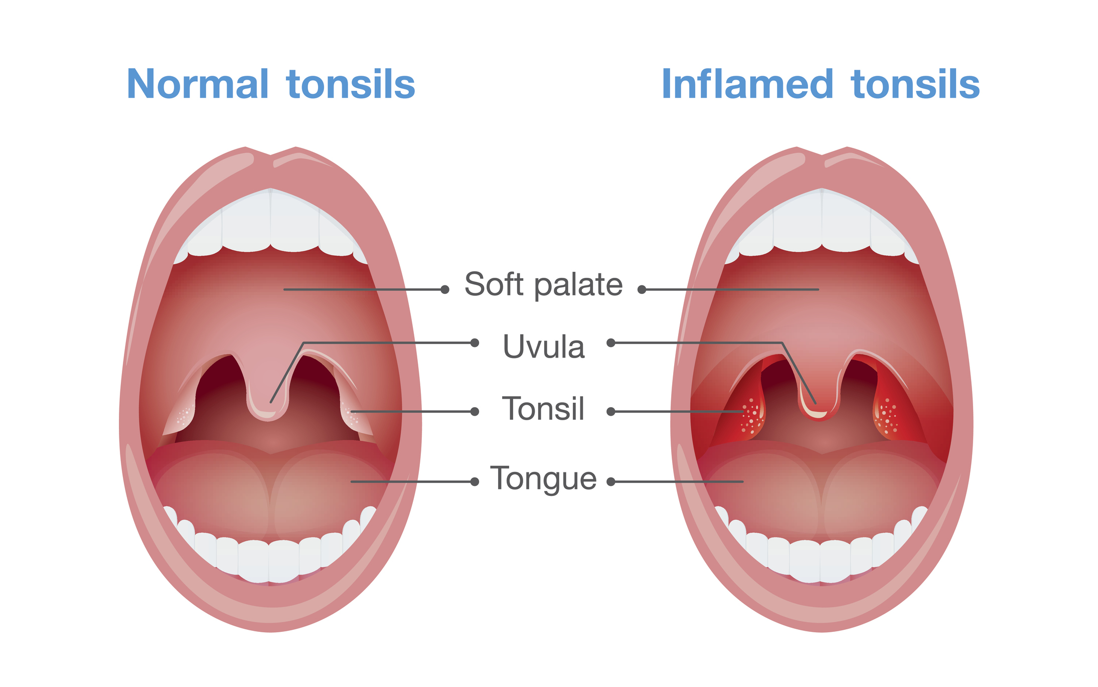 Angina - inflammation i tonsillerna