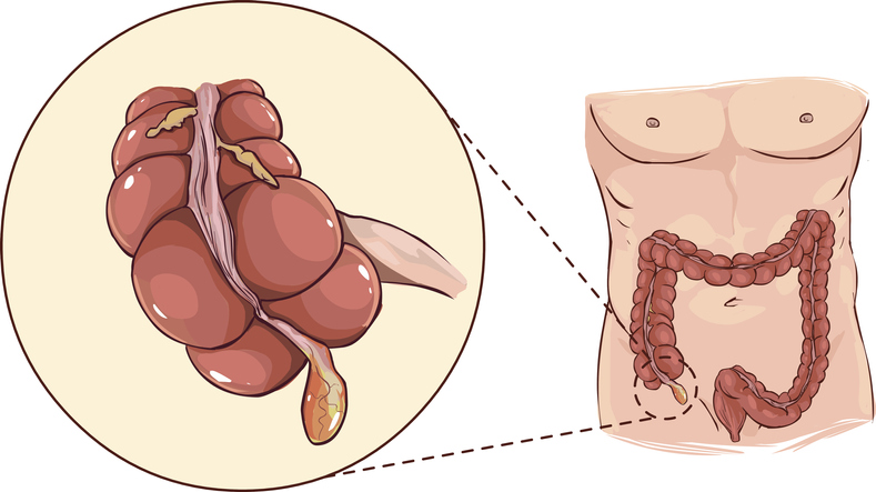 Appendix - anatomisk representation i början av tjocktarmen