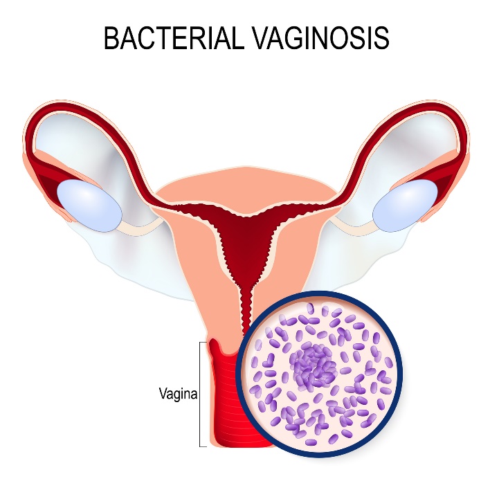 Bakteriell vaginos och överväxt av Gardnerella vaginalis