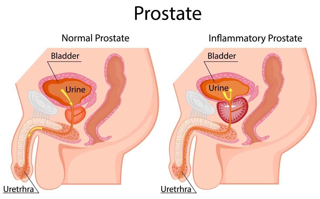 Till vänster: fysiologisk prostata. Till höger: förstorad prostata. Ligger under urinblåsan. Urinblåsa, urin, urinrör.