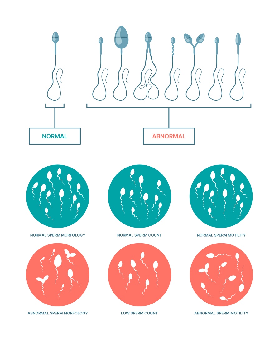 Fysiologiska och onormala tillstånd hos spermatozoer. Spermiernas morfologi, antal och motilitet