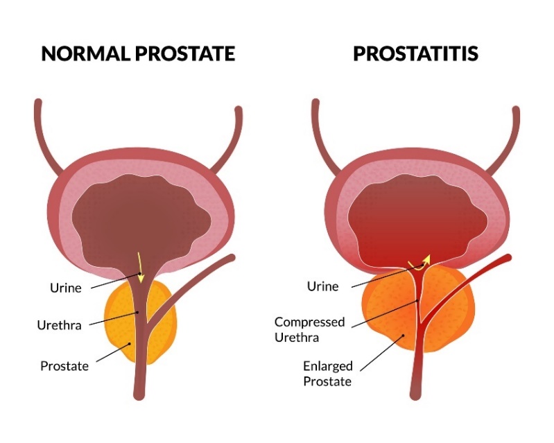 Prostatans fysiologiska tillstånd och prostatit