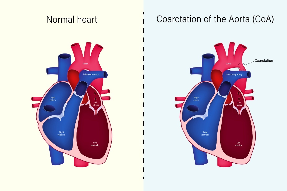 Hjärtats fysiologiska tillstånd och koarktation av aorta (CoA)