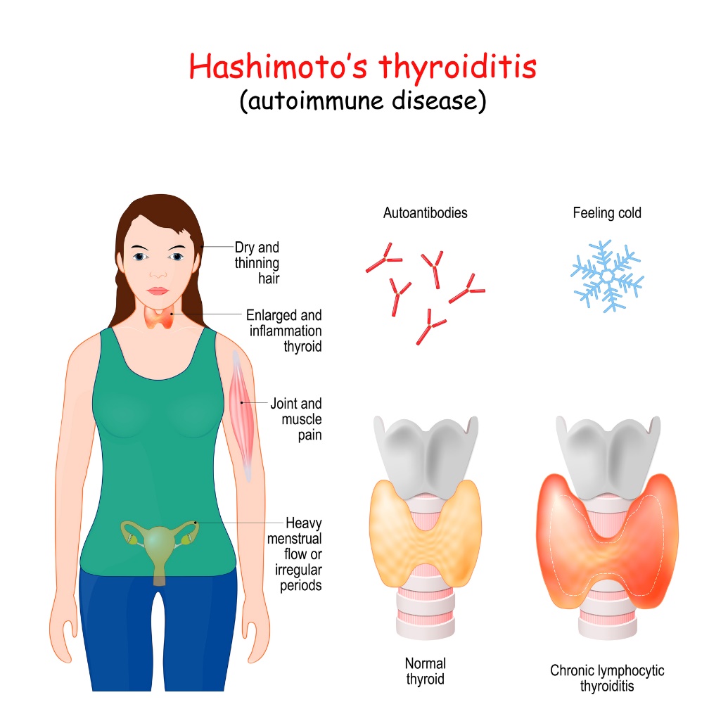 Hashimotos tyreoidit och kliniska symtom