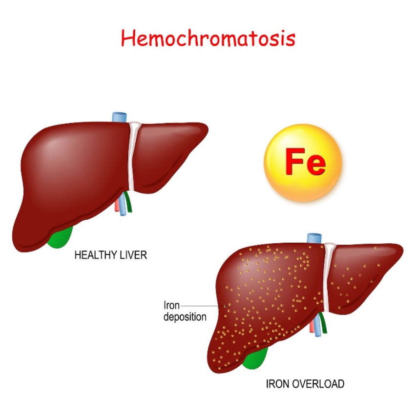 Hemokromatos: fysiologi och patologi i levern med överdriven järn (Fe) deposition