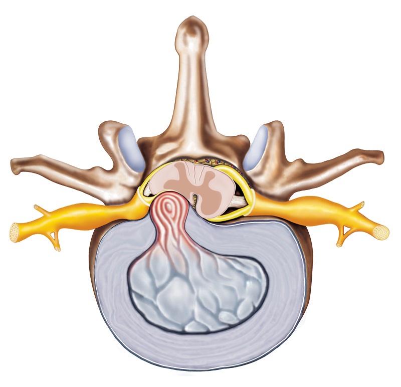 Diskbråck - anatomisk representation