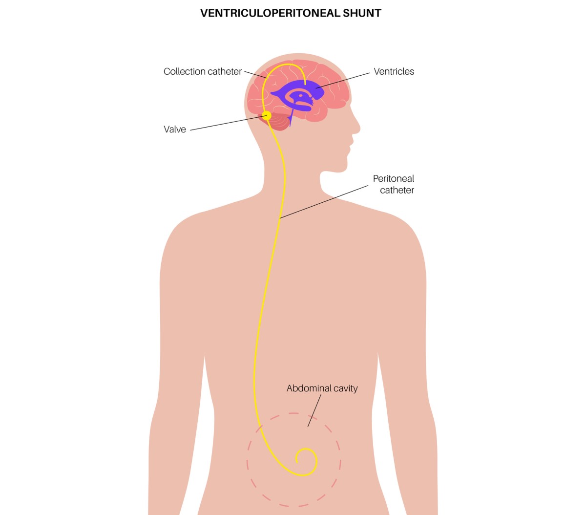 Illustration av en ventrikulo-abdominell shunt som dränerar överflödig vätska från hjärnan till bukhålan.