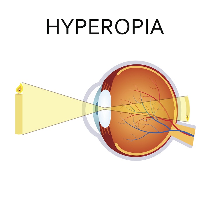 Hyperopi