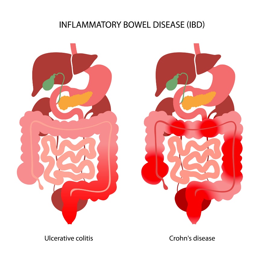 IBD: Indelning i ulcerös kolit och Crohns sjukdom beroende på lokaliseringen av den inflammatoriska reaktionen.