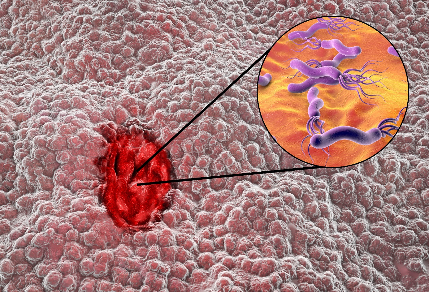 Helicobacter pylori-infektion