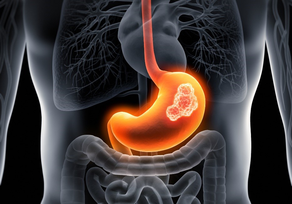 Gastric carcinoma (magsäckscancer) - Anatomisk modell