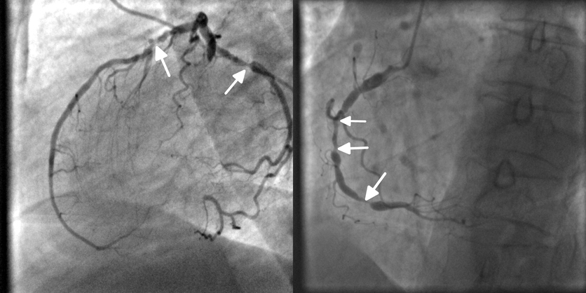 Kranskärlsröntgen, angiografi, blockering av kranskärl