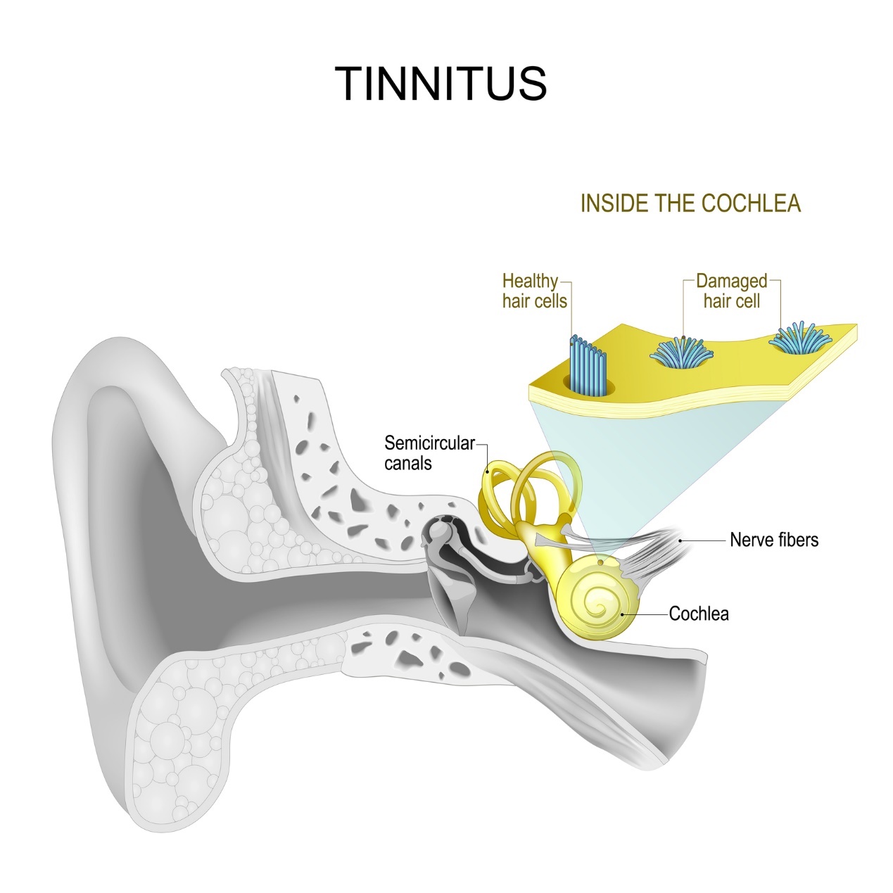 Innerörat och tinnitus - visslande och brummande ljud i örat