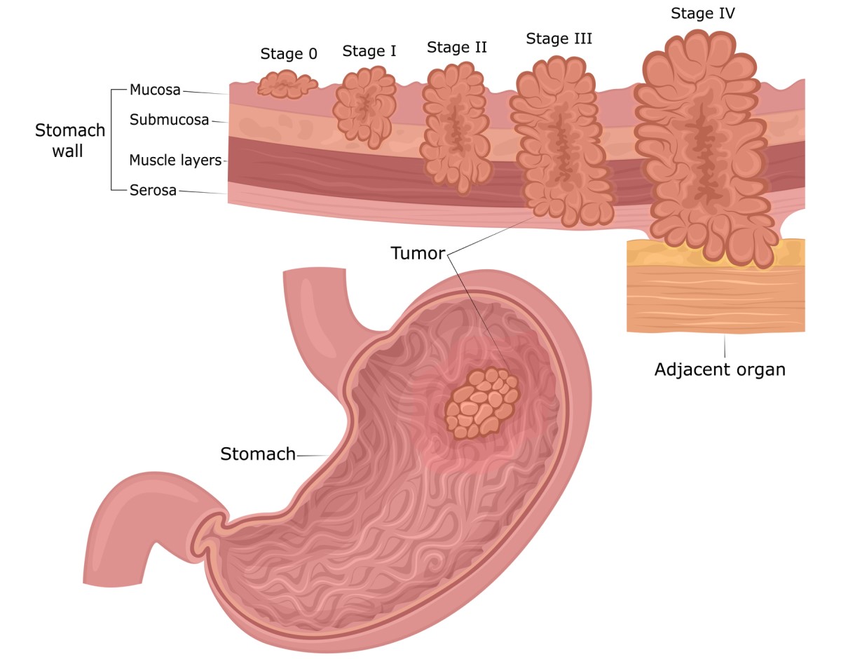 Magsäckscancer: Magsäckens vägglager (mucosa, submucosa, muskel, serosa) och tumörens utvecklingsstadier från mucosan till omgivningen och organen.