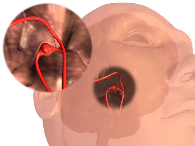 Aneurysm i ett cerebralt blodkärl