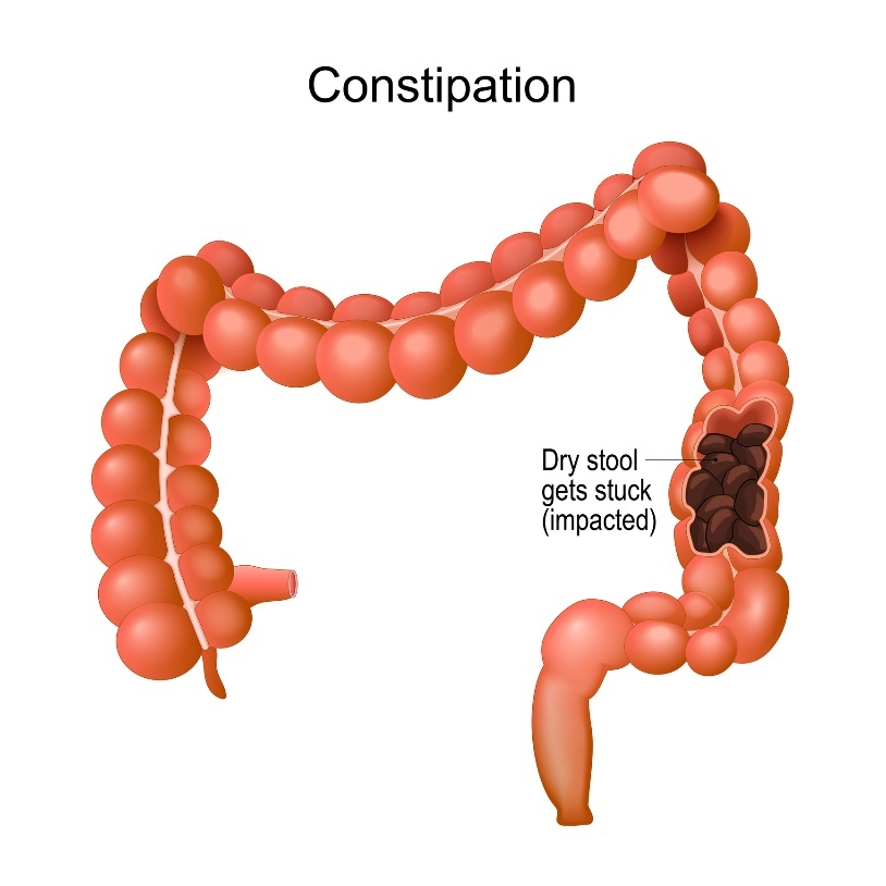 Obstipation (förstoppning)