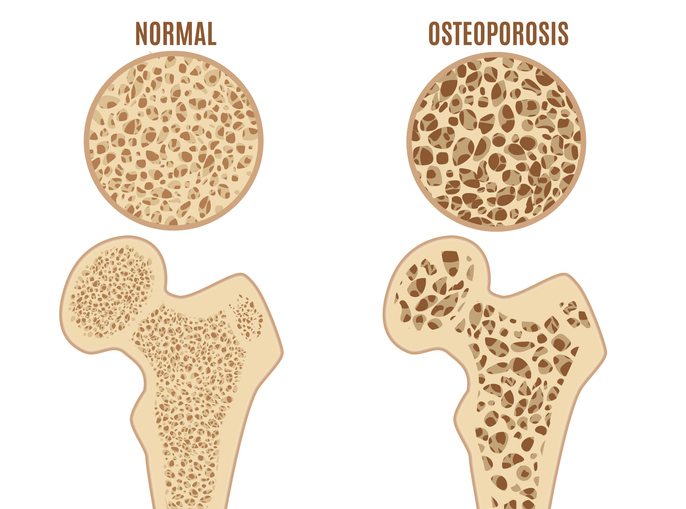 Osteoporos i lårbenet