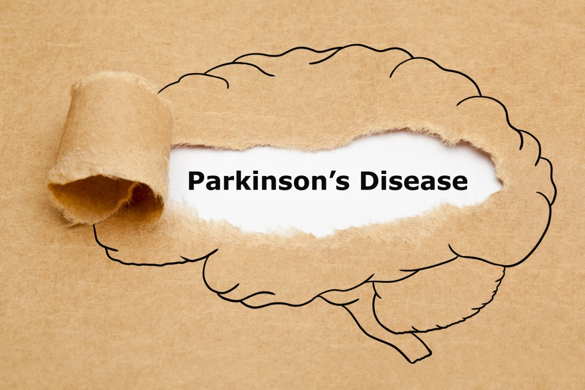 Morbus parkinson = Parkinsons sjukdom = Parkinsons sjukdom - animering av en hjärna med Parkinsons sjukdom i mitten