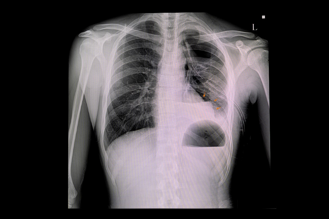 Röntgen av pneumothorax i vänster lunga och luftansamling i bröstkorgens pleurahålighet (vit färg)