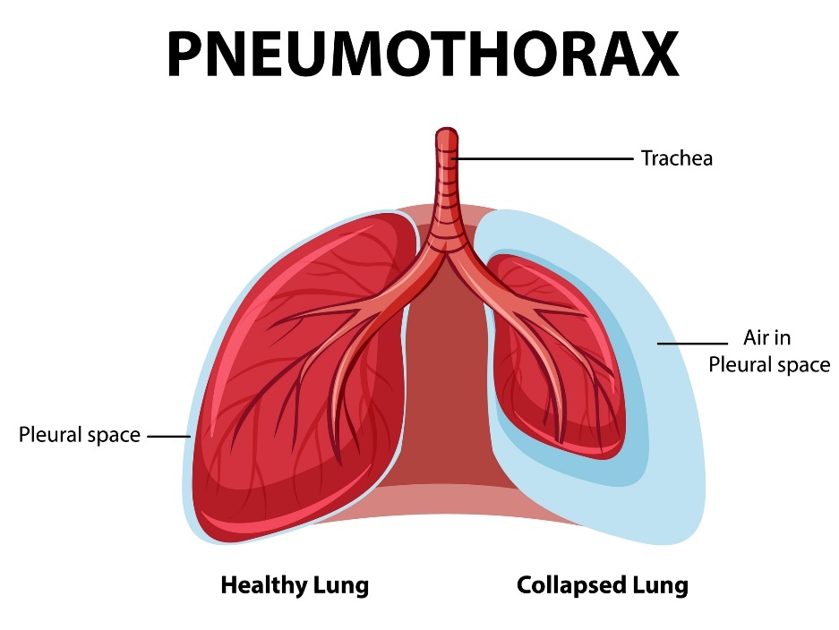 Pneumothorax: friska och kollapsande lungor