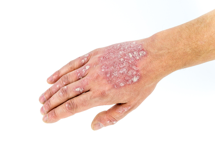 Psoriasis eller psoriasis på handen, handryggen