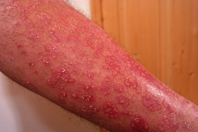 Psoriasis på de övre extremiteterna, på underarmen