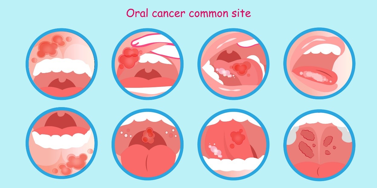 Oral cancer och tumördepåer - en modell