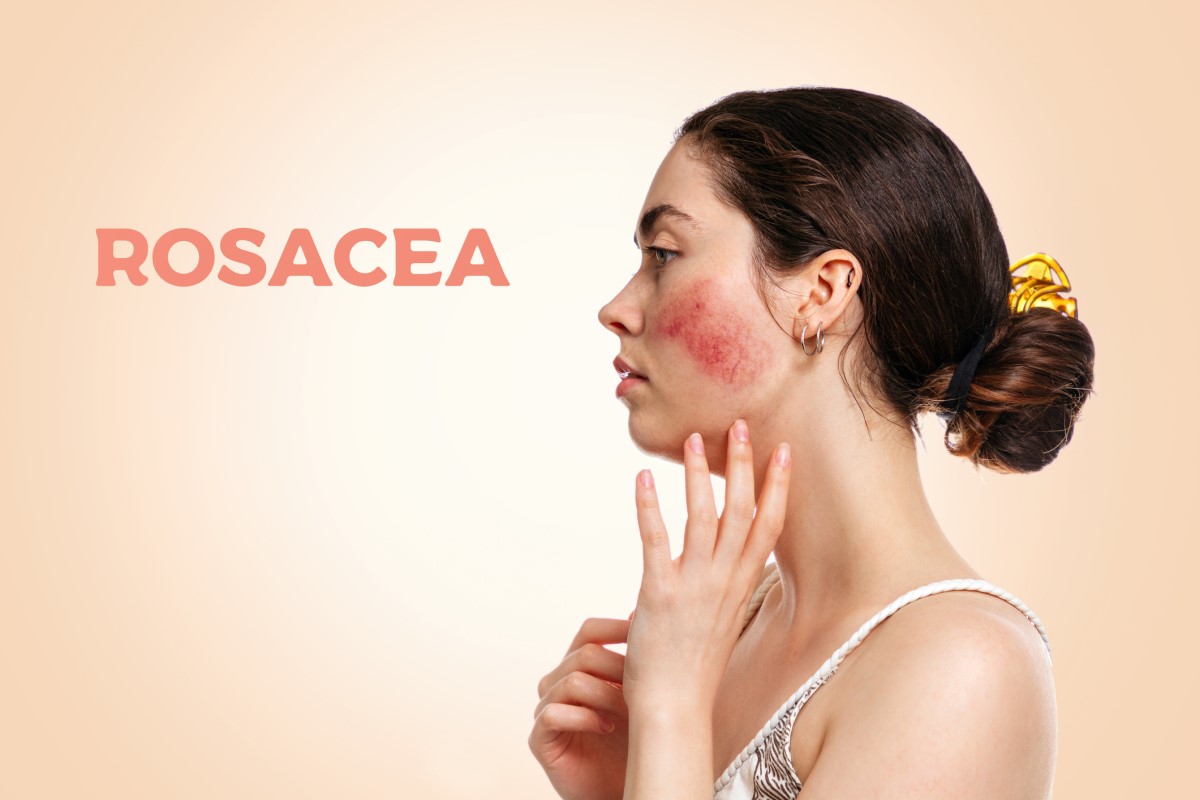 Kvinna från sidan, ansikte med rosacea - rosacea