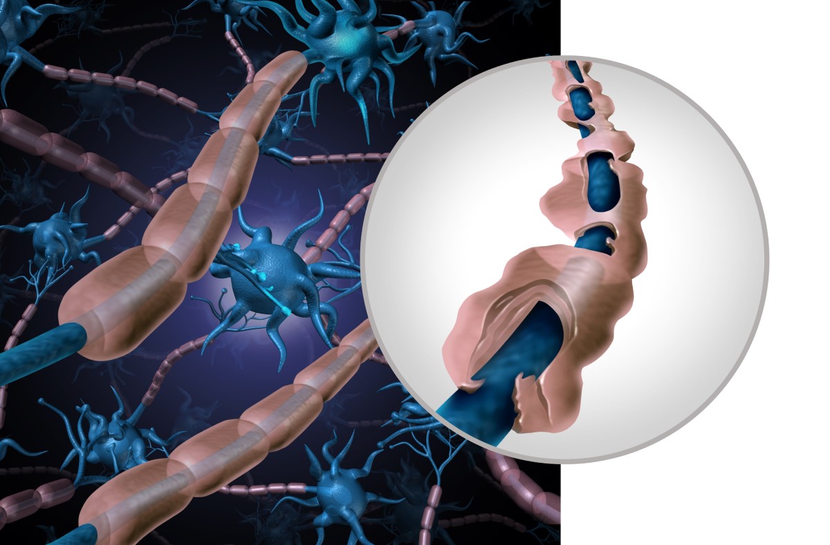 Anatomisk, bildmässig representation av frisk och skadad neuron - demyeliniserad fiber