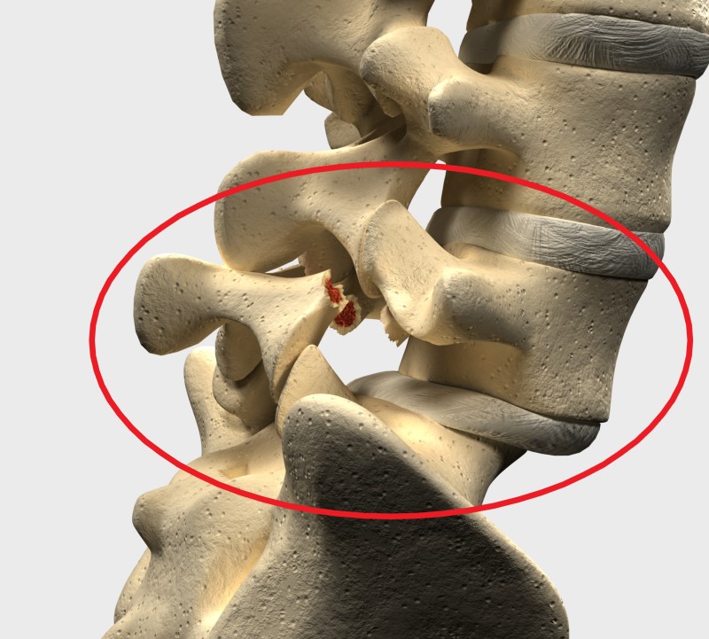 Spondylolisthesis i ländryggen L5 och S1 - modell av ryggradsskelett