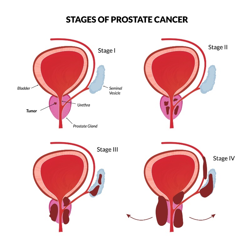 4 grundläggande stadier av prostatacancer