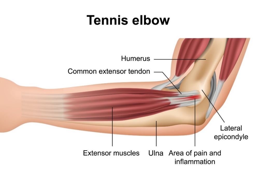 Tennisarmbåge (lateral epikondylit): benen i armbågsleden, sträckmusklerna i underarmen, den laterala epikondylen och platsen för den primära smärtan.