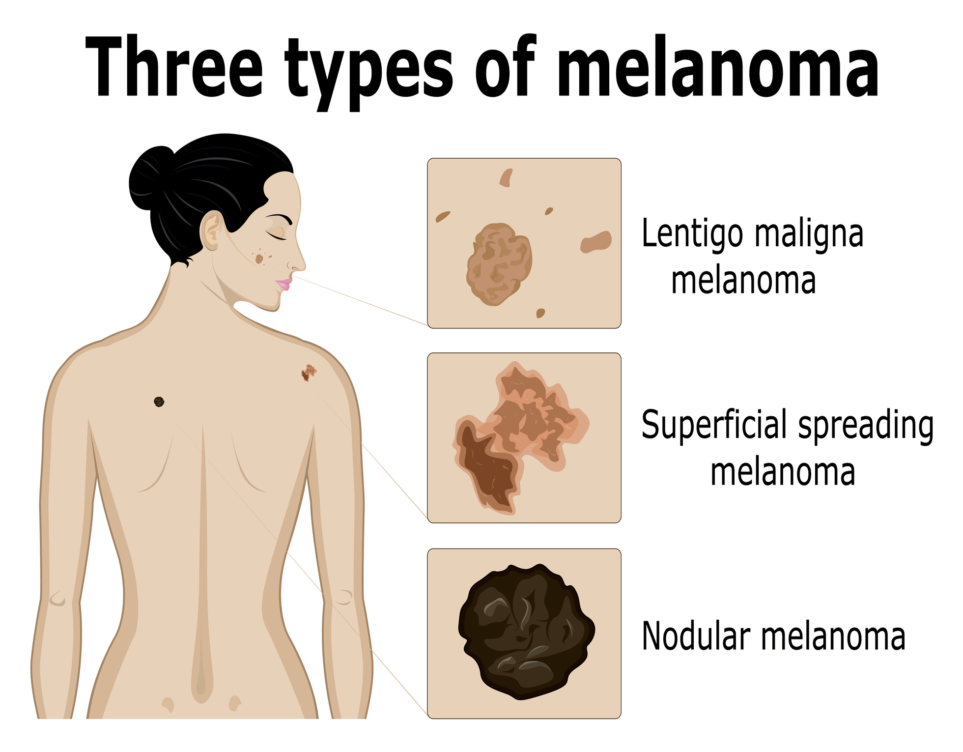 Bilddiagnostik av de tre typerna av melanom