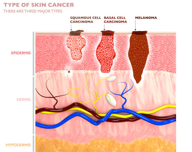 Typer av hudtumörer, deras penetration i huden - skivepitelcancer, basaliom och melanom