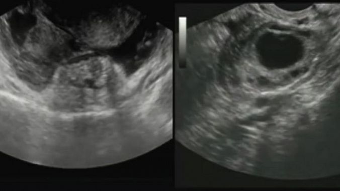 USG - sonografi av buken - bild under undersökning, avbildning av livmodern och utomkvedshavandeskap