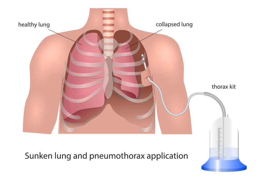 Visualisering av pleuradränage vid pneumothorax: frisk lunga, kollapsad lunga och dräneringsanordning