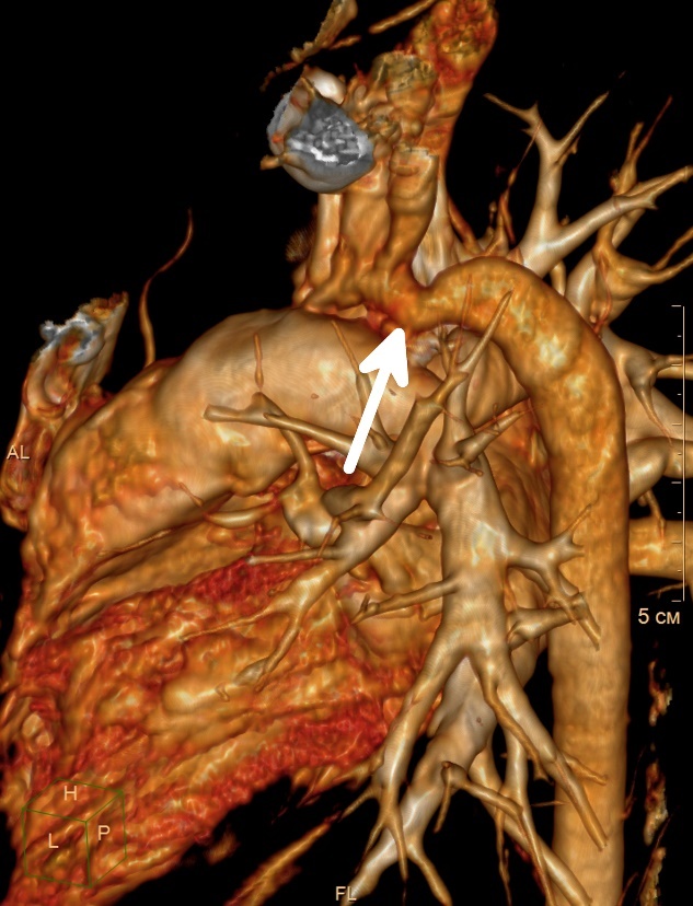 Visualisering av koarktation (förträngning) i aorta i den nedåtgående delen av hjärtats kärl.