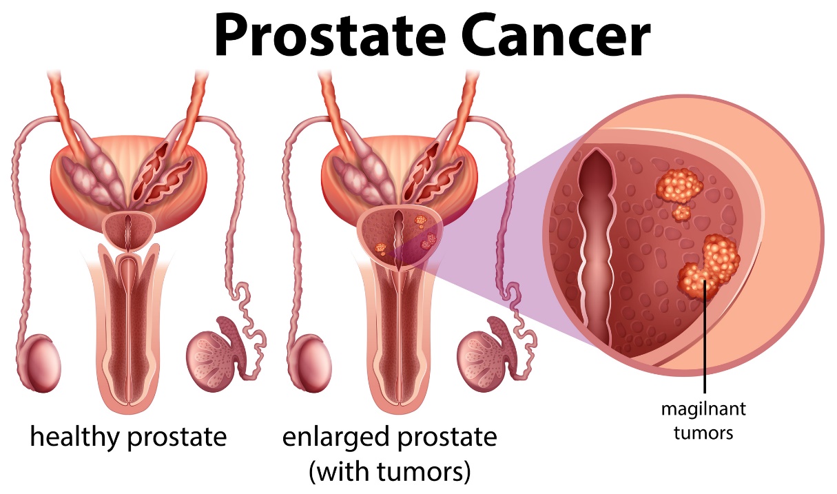 Prostatacancer: frisk prostata och förstorad prostata med tumör