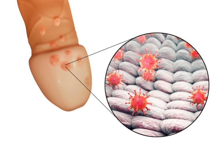 genital herpes på penis och herpesvirus på mikroskopisk nivå