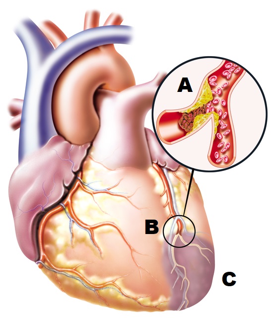 anatomisk ritning av hjärtat med ett blockerat blodkärl