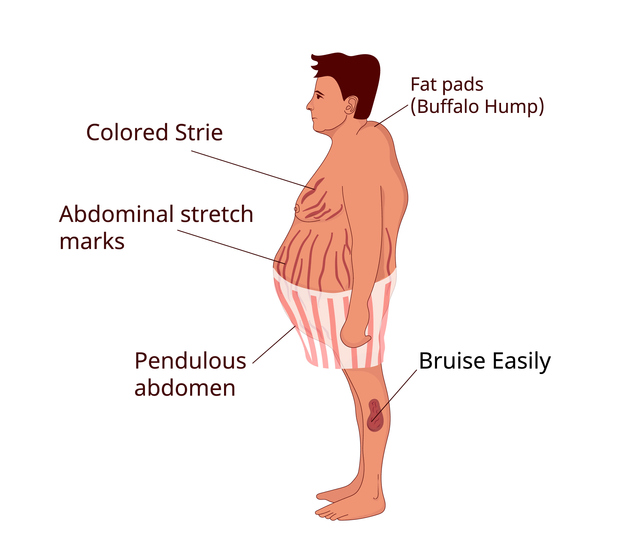 Cushings syndrom