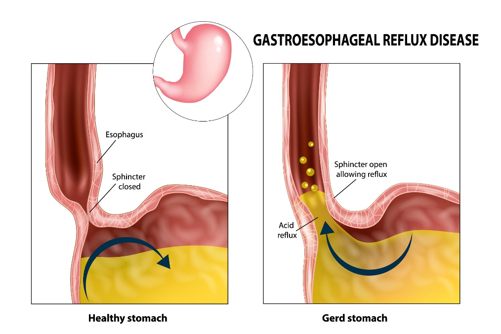 Gastroesofageal reflux: matstrupe, sfinkter, mage och magsyra