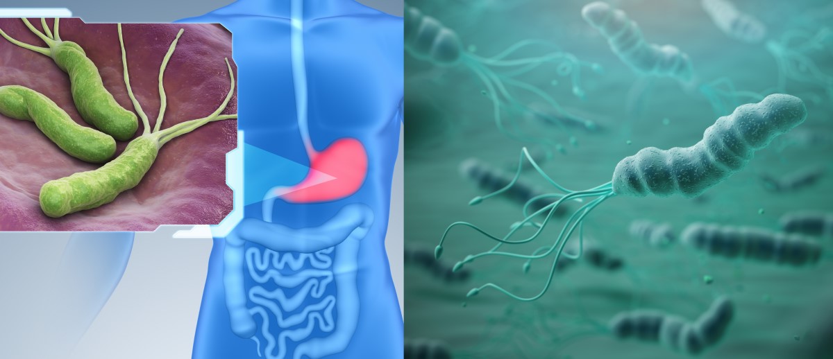 Helicobacter pylori koloniserar magslemhinnan och är en riskfaktor för gastrit, magsår och cancer.