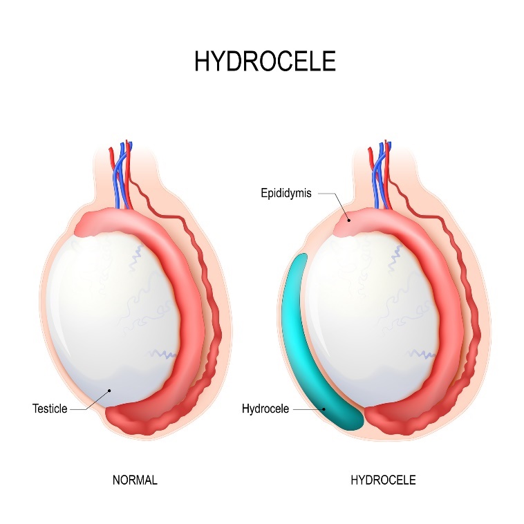 Hydrocele: testikel, epididymis, Hydrocele (ansamlad vätska)