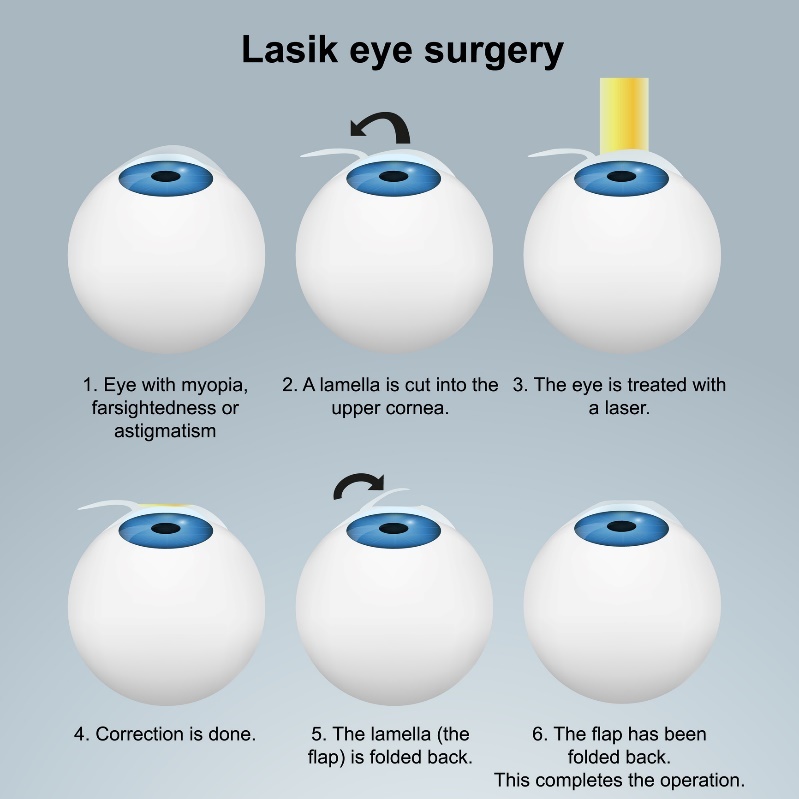 Ögonlaseroperation LASIK - subsurface-metoden. Förfarande med klaff/flap utan att skada nervändarna.