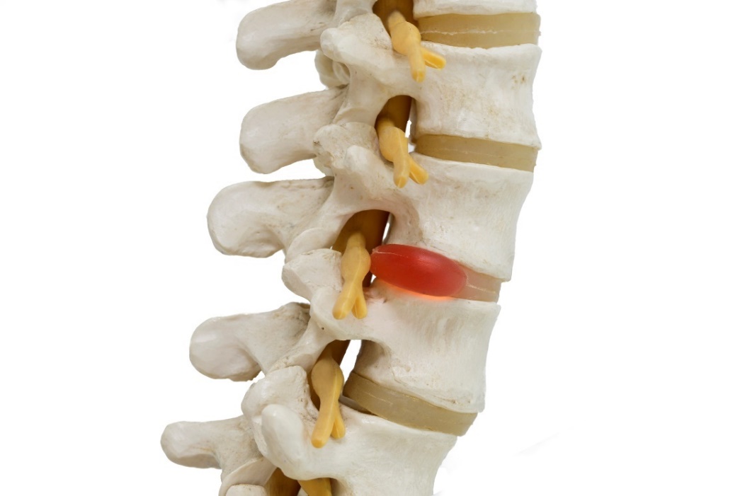 Anatomisk framställning av en 3D-modell av ryggraden, mellankotskivorna och diskbråck med nervkompression