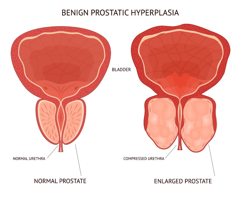 Godartad (benign) förstoring av prostatan. Blåsa (bladder), fysiologisk och förstorad vävnad i prostataorganet.